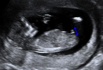 Fetal Medicine - Blog - male fetus 12 weeks old