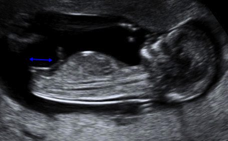 Fetal Medicine - Blog - female fetus at 12 weeks