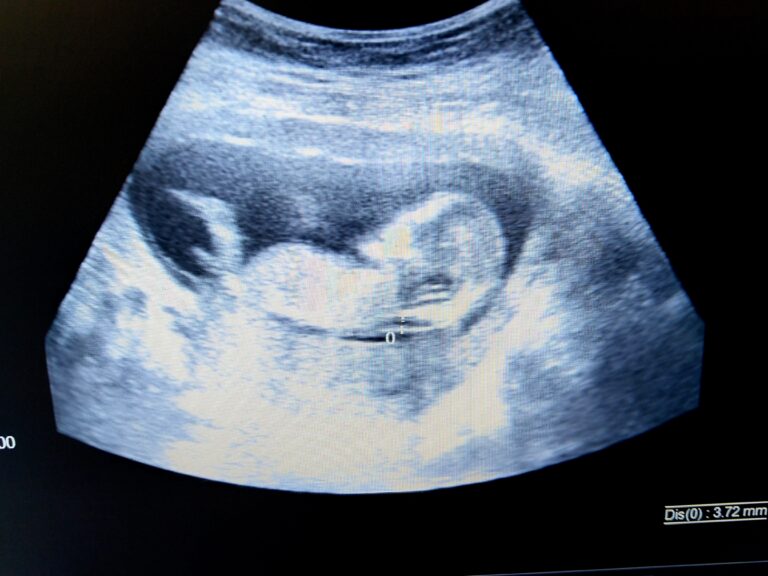 12 week 3d ultrasound gender