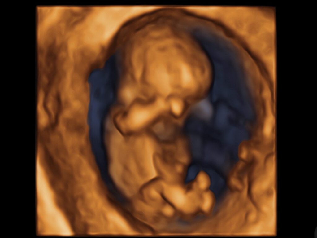 Fetal Medicine - Baby Scans - 3D/4D scan image 2