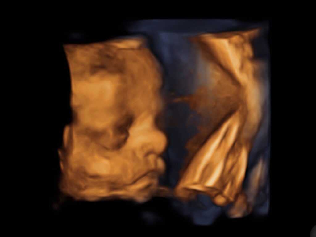 Fetal Medicine - Baby Scans 3D/4D Scans